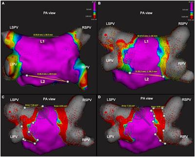 Ultra-high-resolution assessment of lesion extension after cryoballoon ablation for pulmonary vein isolation